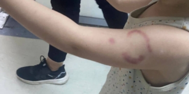 ÖZEL KREŞİN ÖĞRETMENİ ÇOCUĞA FELAKETİ YAŞATTI: İDDİAYA GÖRE ÖĞRETMEN ÇOCUĞUN KOLUNU ISIRDI