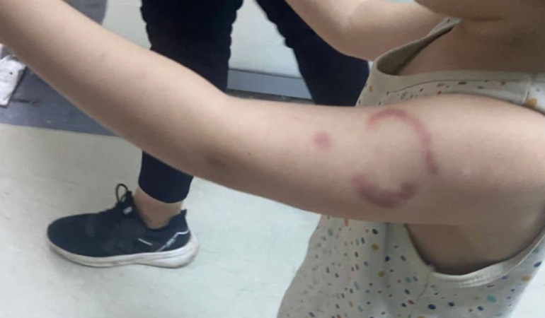 ÖZEL KREŞİN ÖĞRETMENİ ÇOCUĞA FELAKETİ YAŞATTI: İDDİAYA GÖRE ÖĞRETMEN ÇOCUĞUN KOLUNU ISIRDI