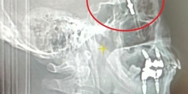 BEYNİNE SAPLANAN İMPLANT HAYATINI KARARTTI: 2 YILDIR ADALET BEKLİYOR