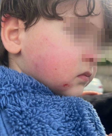 Kreşe bıraktığı çocuğunu darp edilmiş halde aldı